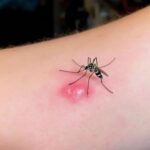 How To Prevent Mosquito Bites